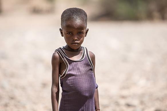  Why do malnourished children have big bellies?  